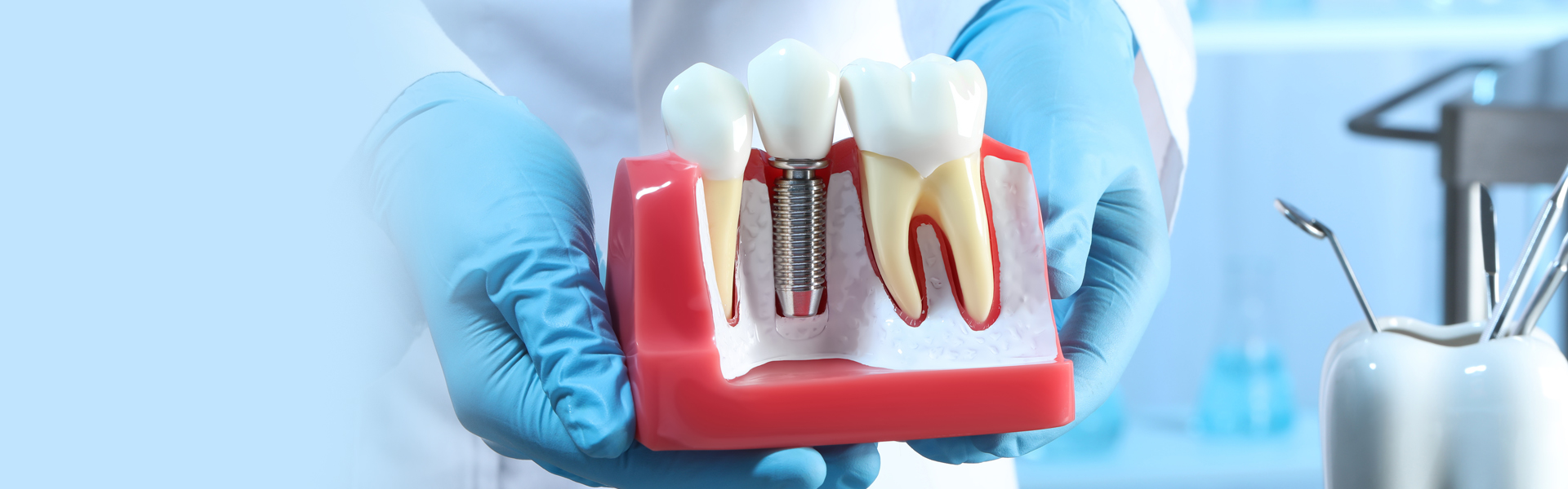In-Depth Guide to Dental Implant Restoration