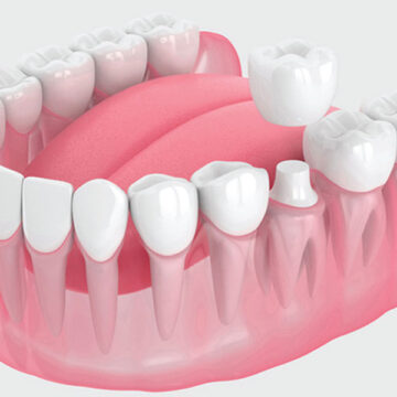 Dental Crown: Types, Procedure, and Care