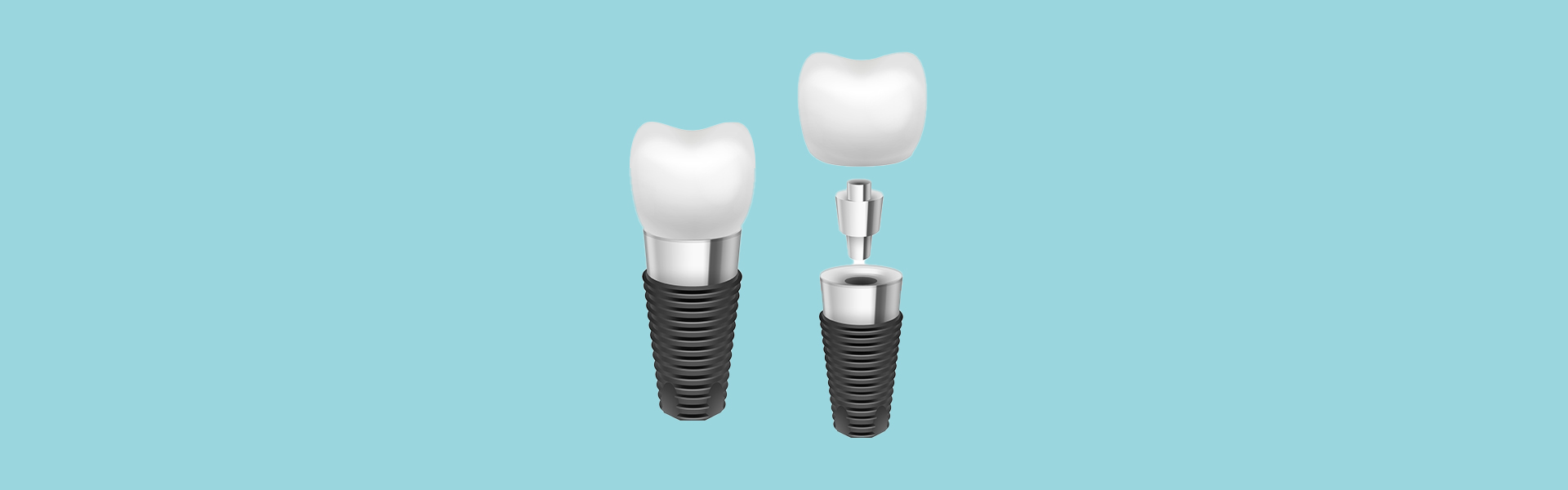 What Are Dental Implants? A Complete Guide to Tooth Replacement