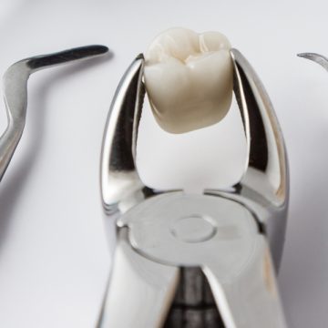 When Is Tooth Extraction Necessary? Signs You Should Know